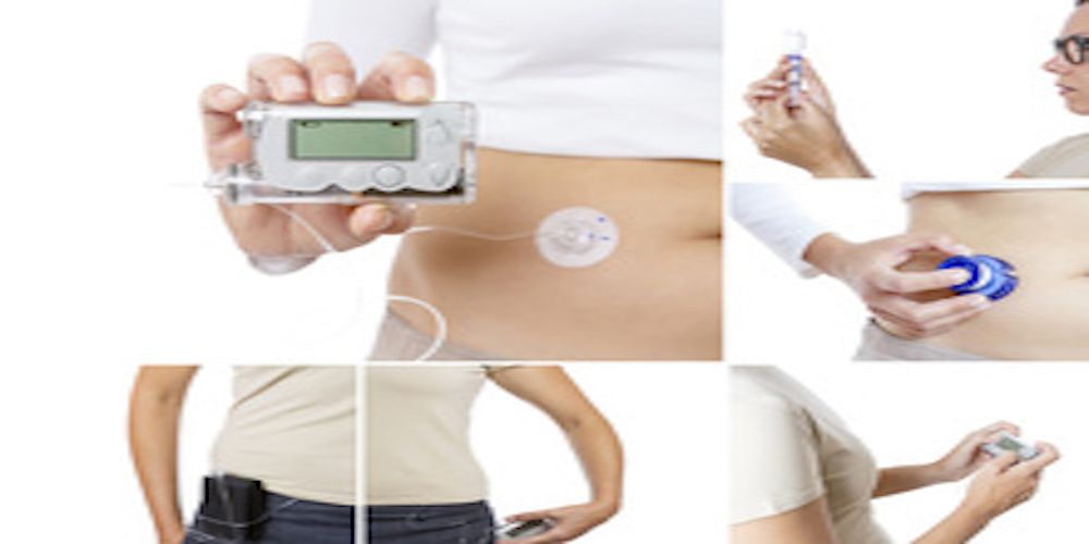 Image of an insulin pump