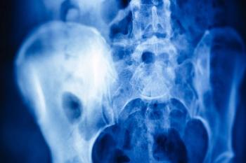 Hip bone density deficits in leukemia survivors were smaller with longer time since diagnosis in lower-risk groups but not after high-risk ALL therapy. | Image credit: yurakrasil - stock.adobe.com