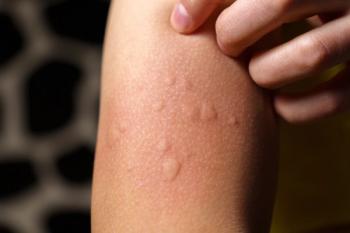 Skin hives. | Image Credit: Алексей Филатов - stock.adobe.com 