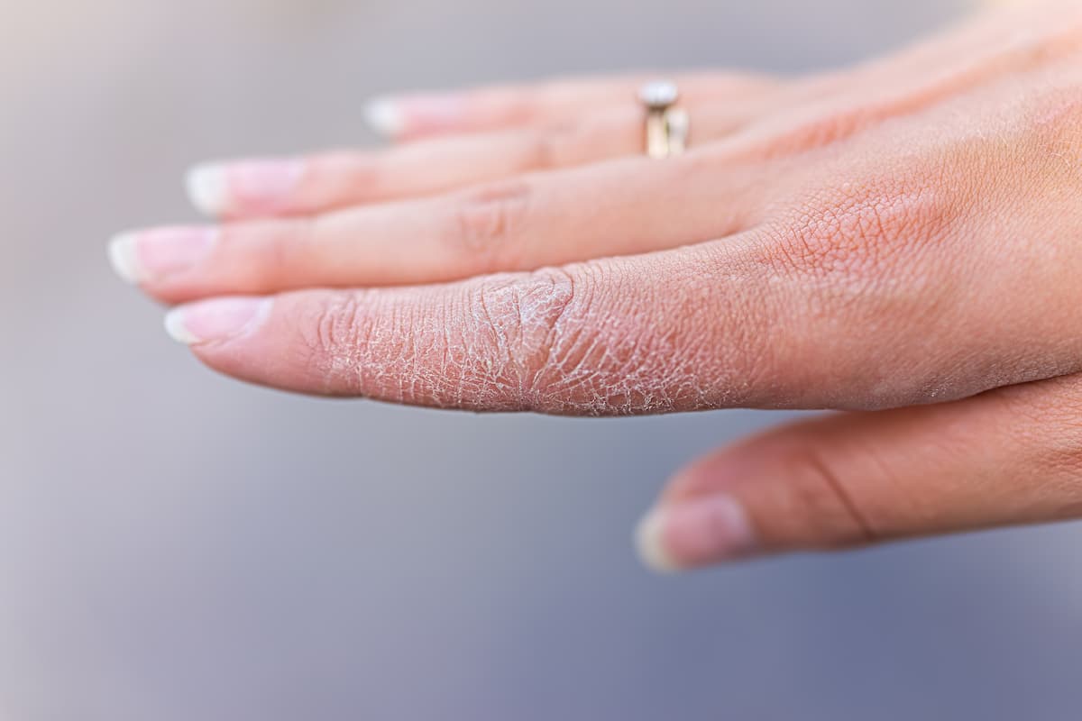 Delgocitinib Leads to Strong 16-Week Improvement in Chronic Hand Eczema