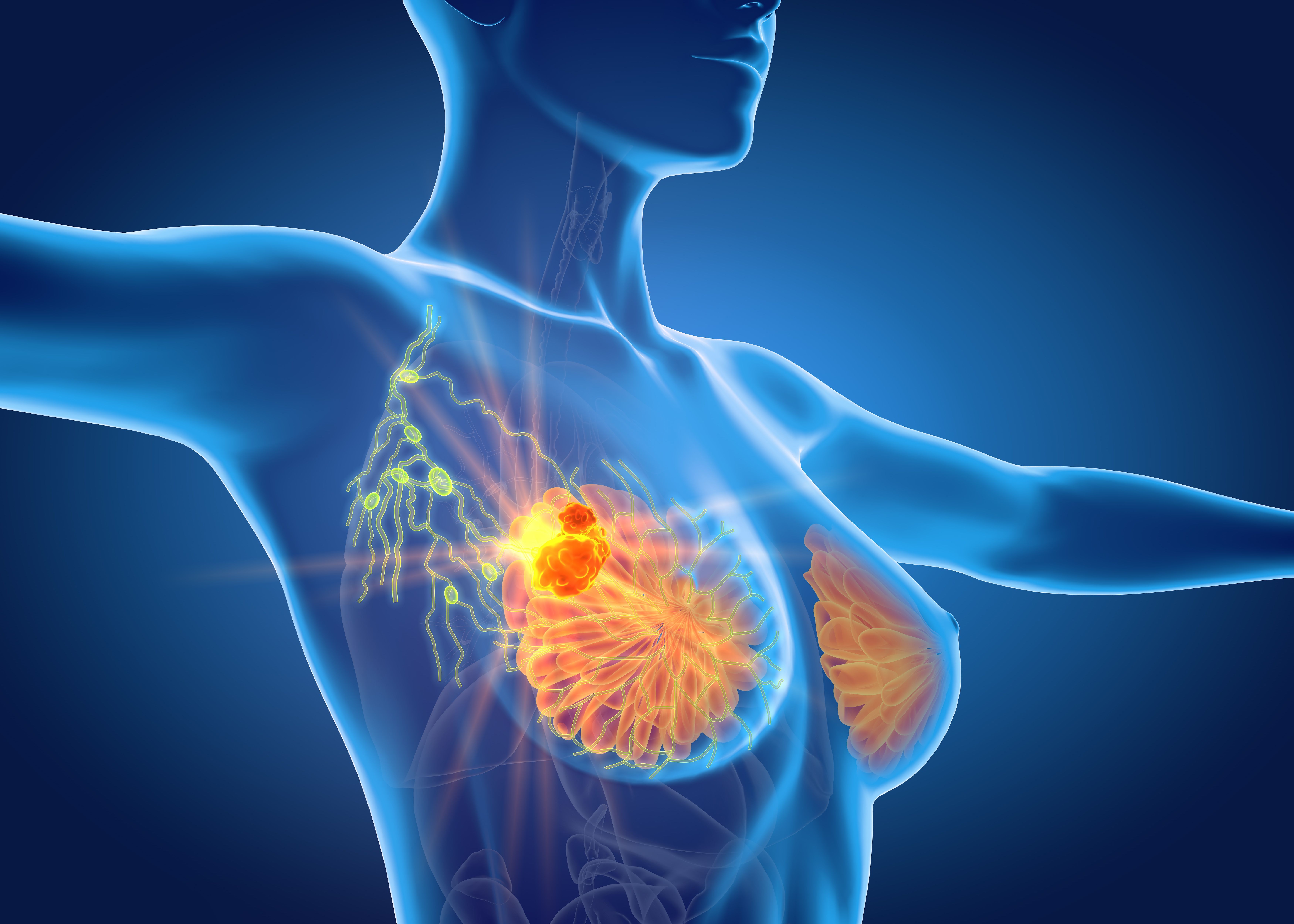 Low Adherence to Endocrine Therapy Highlights Urgent Need in the Breast Cancer Space - AJMC.com Managed Markets Network