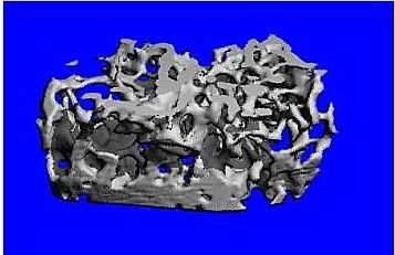 Blocking Cell Signals Points to Possible Treatment for Osteoporosis