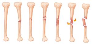 Leg Fracture Stages | image credit: GraphicsRF - stock.adobe.com