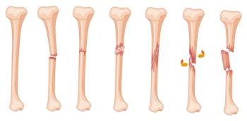 Leg Fracture Stages | image credit: GraphicsRF - stock.adobe.com