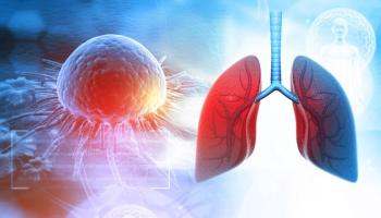 Human lungs with cancer cells| Image Credit: Rasi-stock.adobe.com