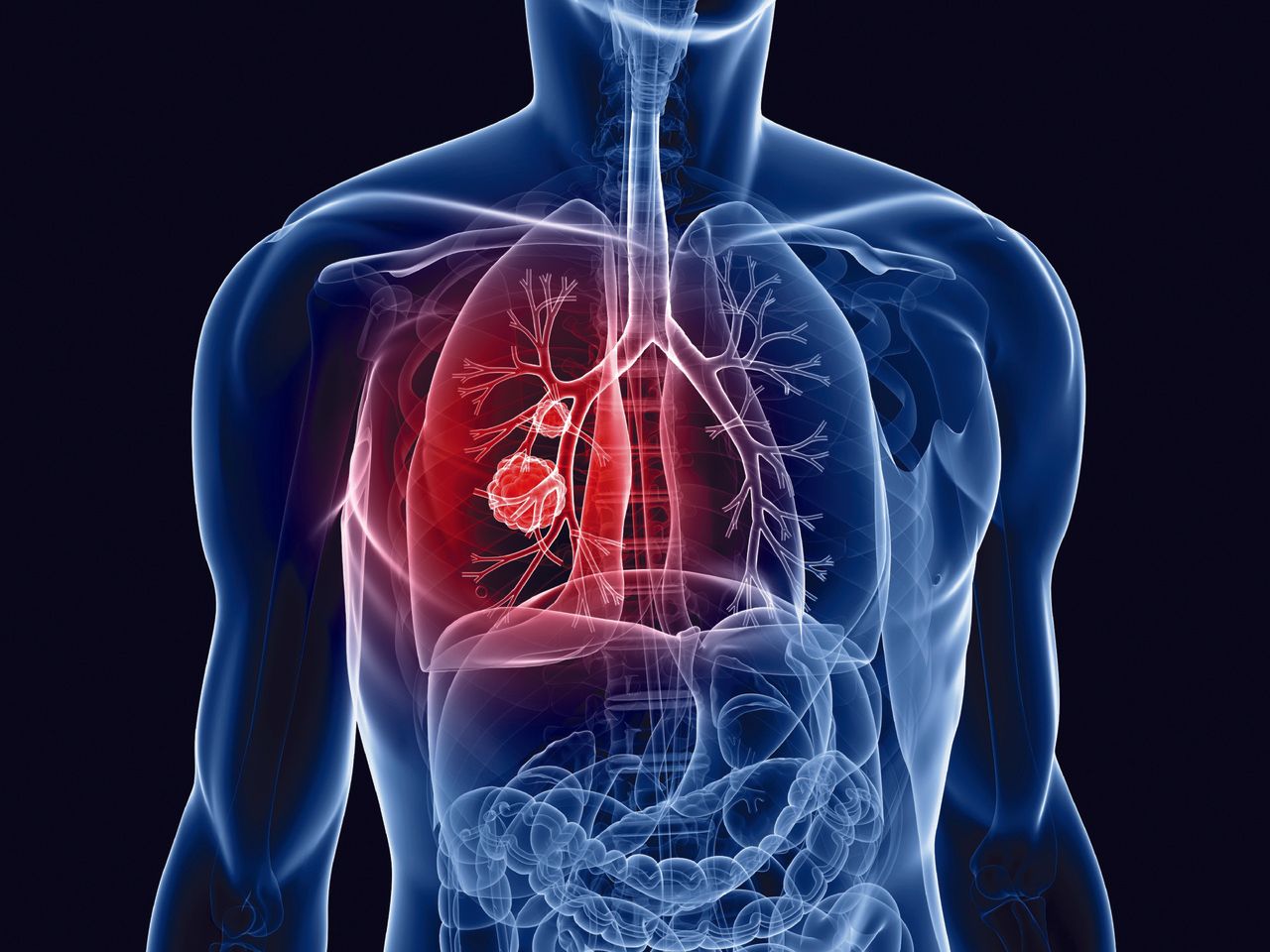 Lung Cancer