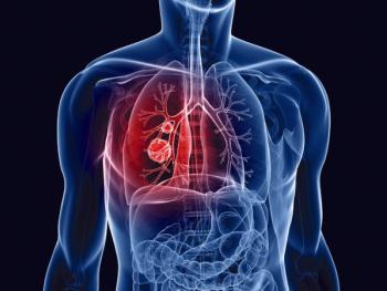 lung cancer