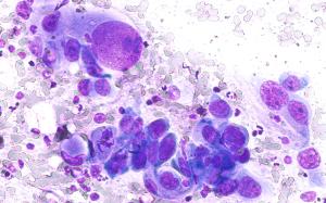 Weighing Relapse Risk Against Benefit in Advanced NSCLC Immunotherapy: Jonathan Thompson, MD, MS