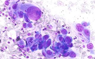 Weighing Relapse Risk Against Benefit in Advanced NSCLC Immunotherapy: Jonathan Thompson, MD, MS