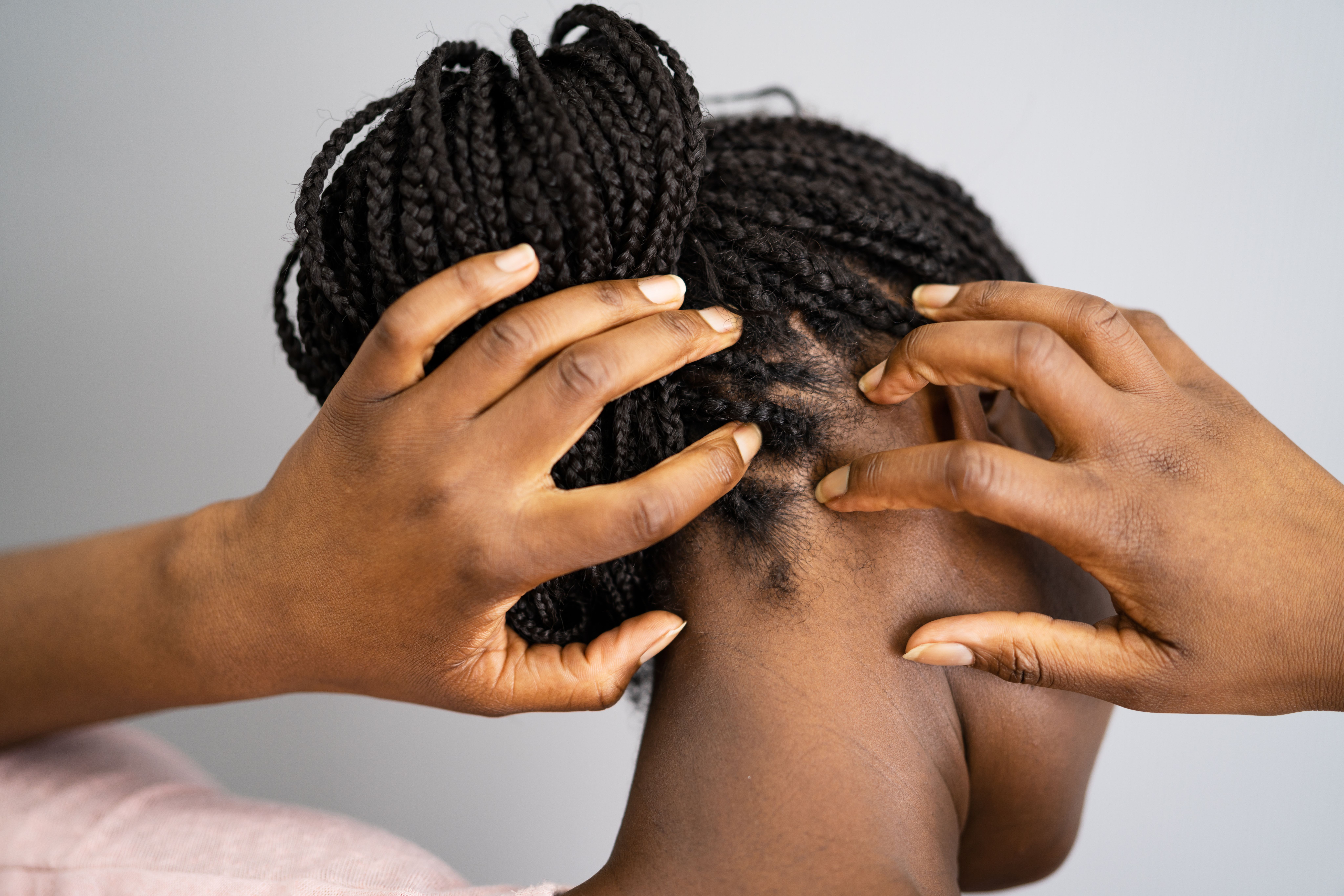 Evaluating Hair Camouflage as a Tool for Black Women With Alopecia: A  Critical Review | AJMC