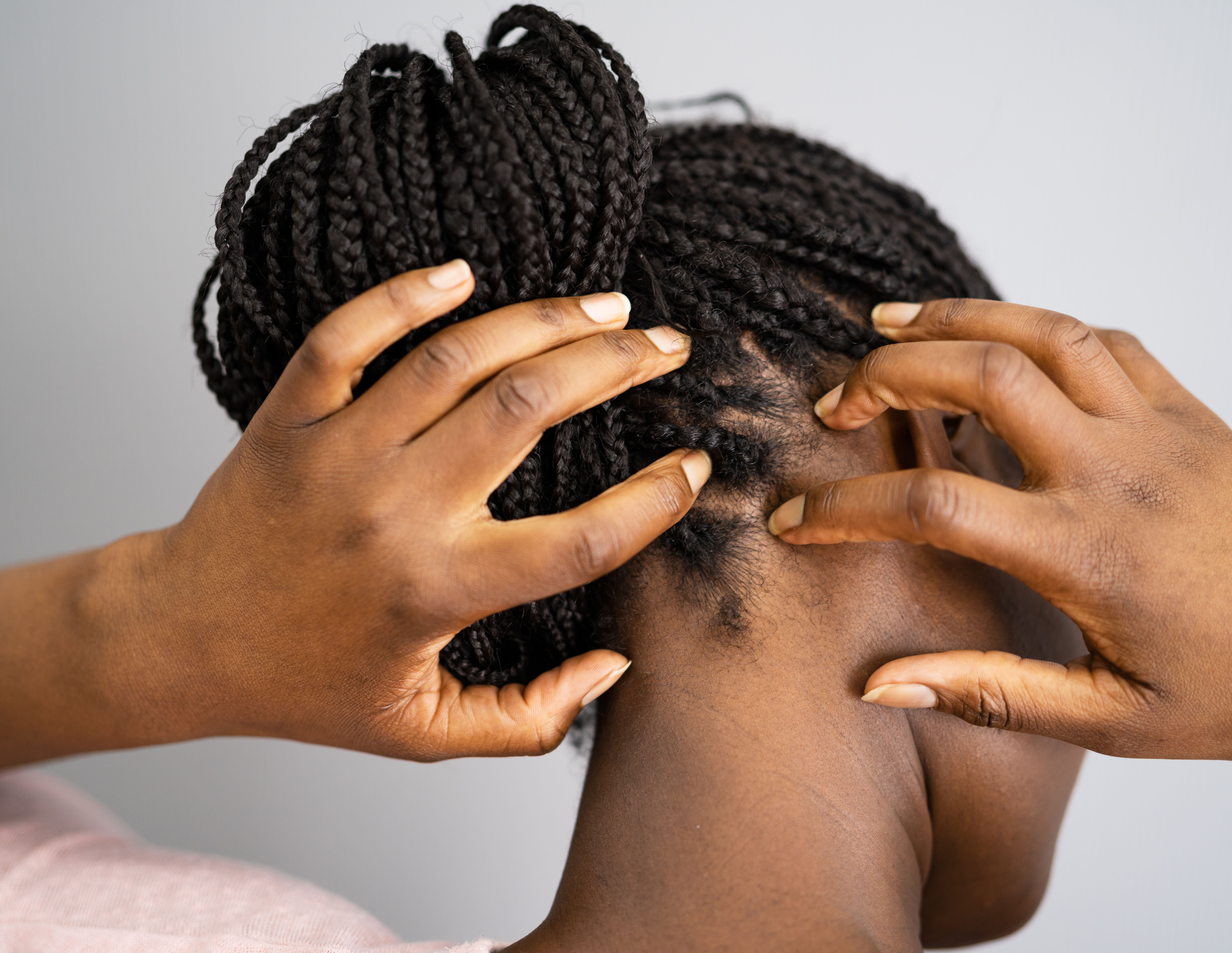 Evaluating Hair Camouflage as a Tool for Black Women With Alopecia: A Critical Review | AJMC Evaluating Hair Camouflage as a Tool for Black Women With Alopecia: A Critical Review | AJMC