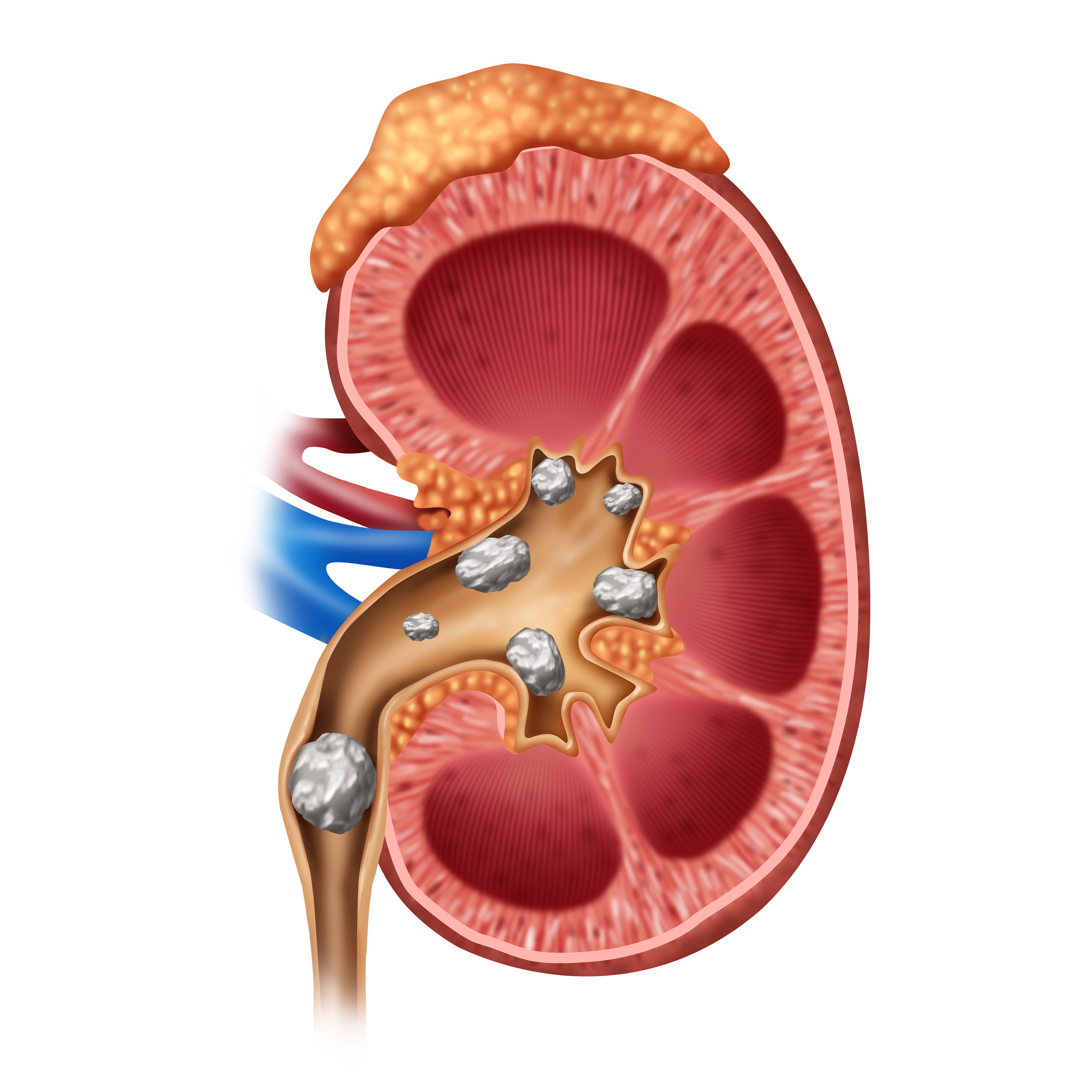 Analysis Looks at SGLT2 Inhibitors Across Diabetes, Heart Failure, CKD