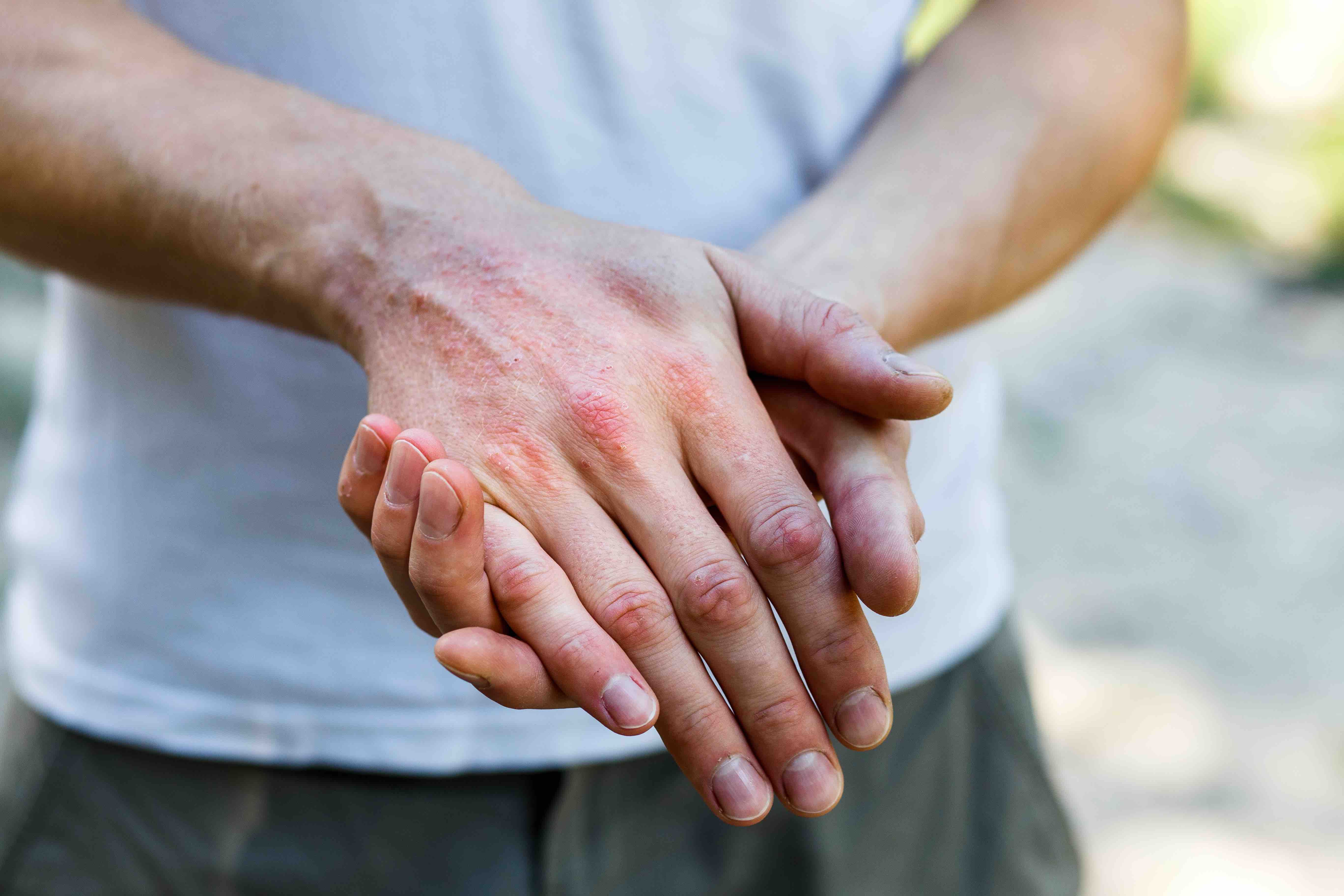 Yearly Flares in Atopic Dermatitis May Predict Disease Severity