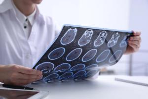 Multiple sclerosis | Image credit: New Africa - stock.adobe.com