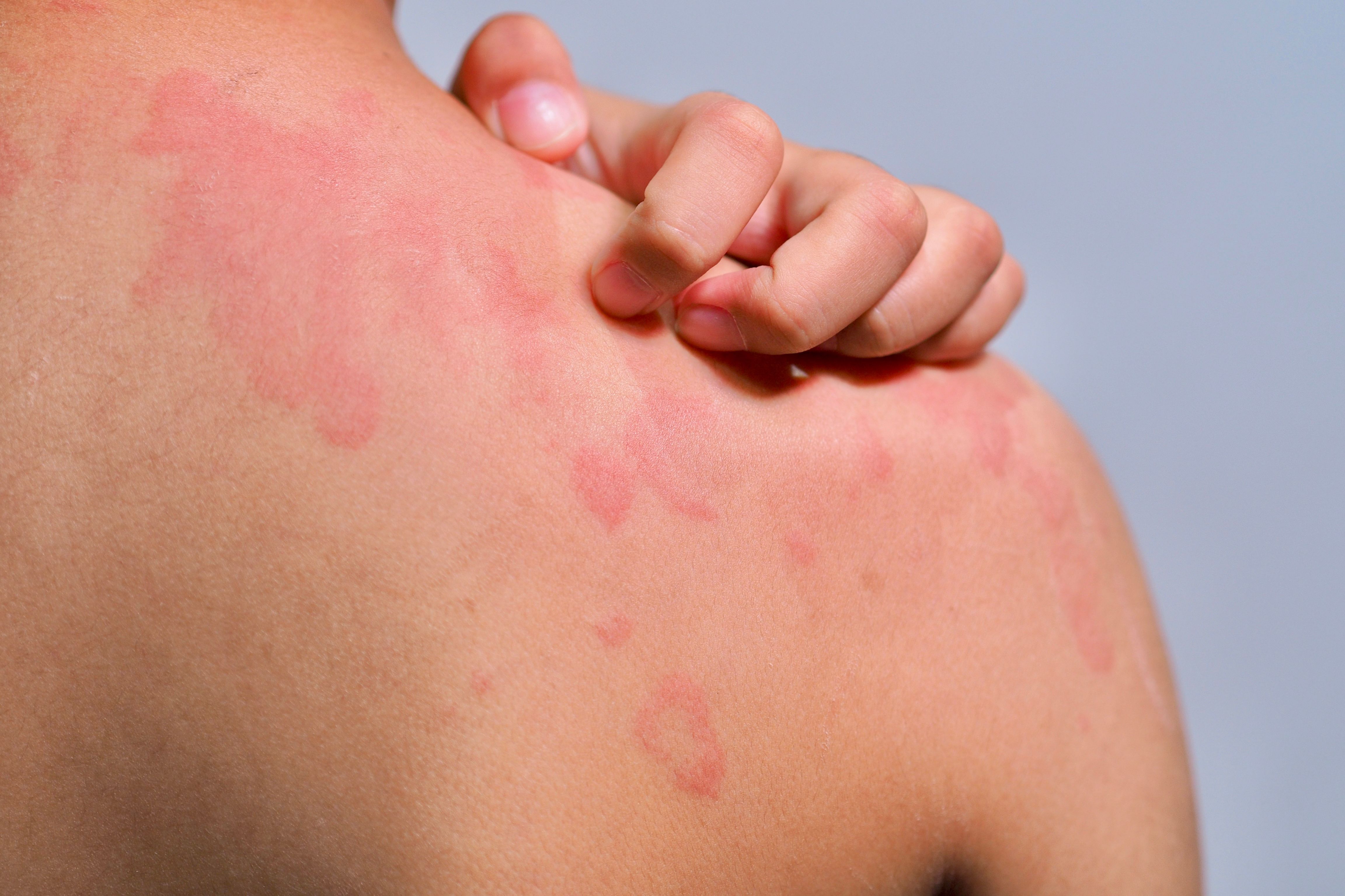 Hives, allergy. | Image Credit: Tanapat Lek,jew - stock.adobe.com