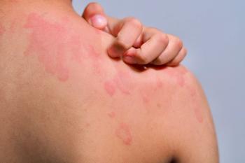 Hives, allergy. | Image Credit: Tanapat Lek,jew - stock.adobe.com