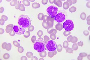 Researchers Form Novel Database of Leukemia Transcriptome Profiles