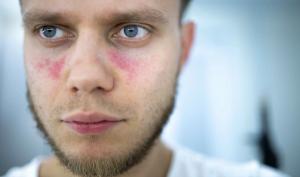 Man With Lupus Erythematosus | image credit: velimir - stock.adobe.com