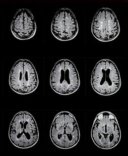 Higher Strength MRI Offers Greater Detection of Cortical Lesions in MS