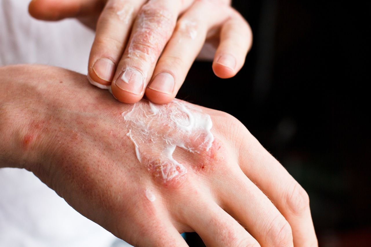 Survey: Why Patients With Psoriasis Turn to Complementary and Alternative Medicines