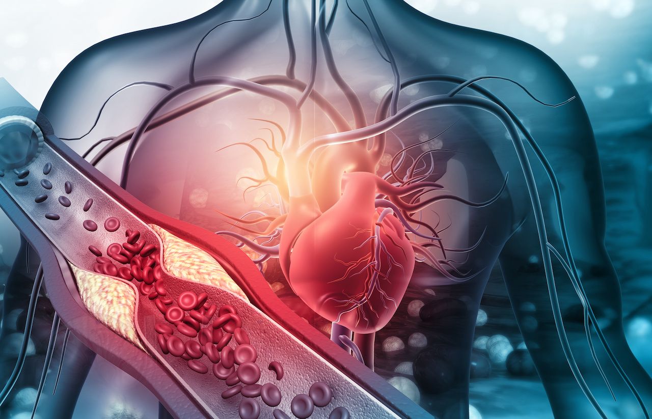 Image of a right ventricle straining: Rasi - stock.adobe.com