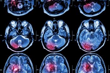 Brain MRI | Image credit: stockdevil - stock.adobe.com