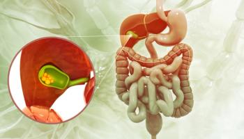 gallstones | Image credit: Crystal light - stock.adobe.com