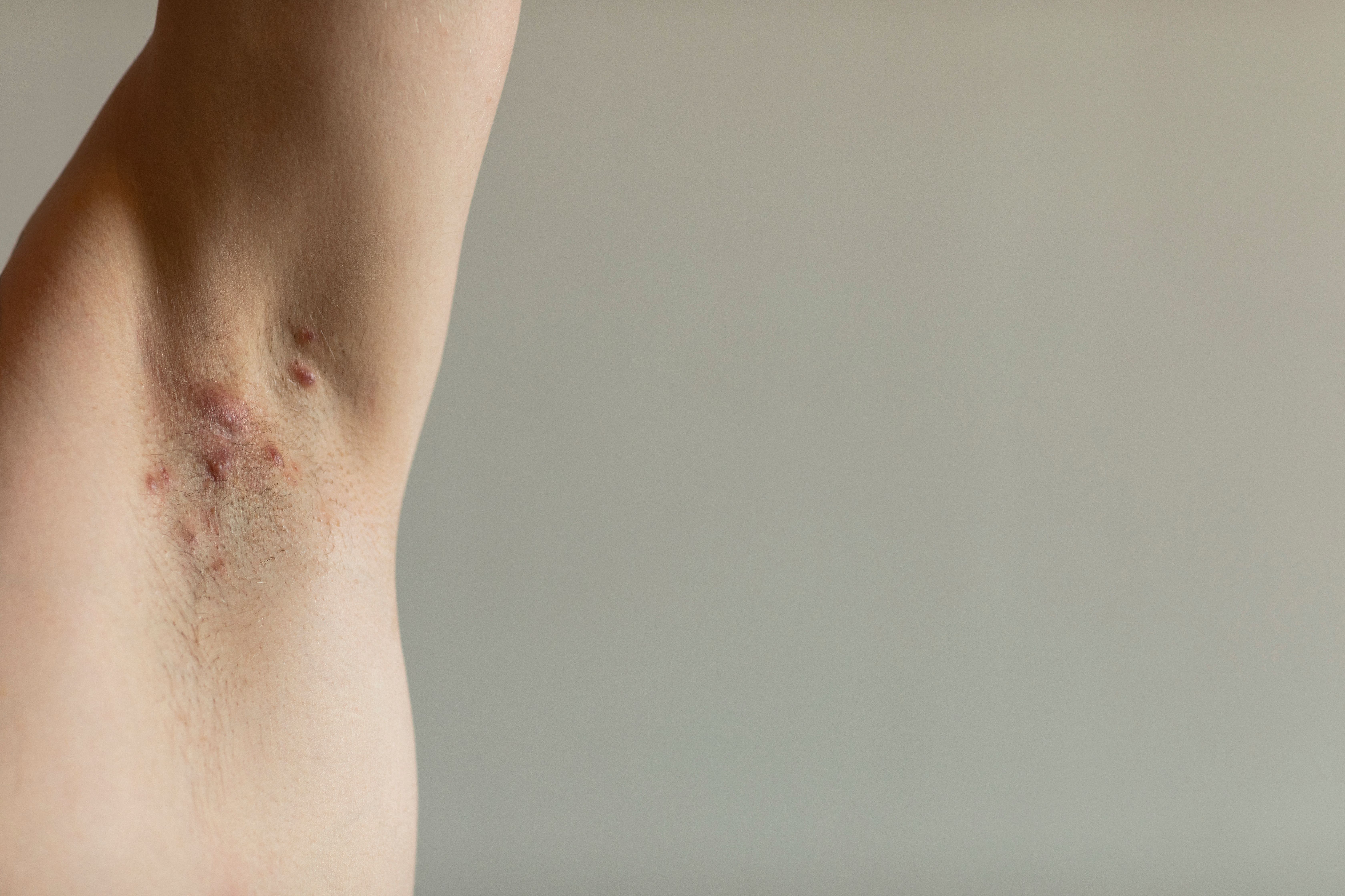 Hidradenitis suppurativa | Image credit: Lea - stock.adobe.com