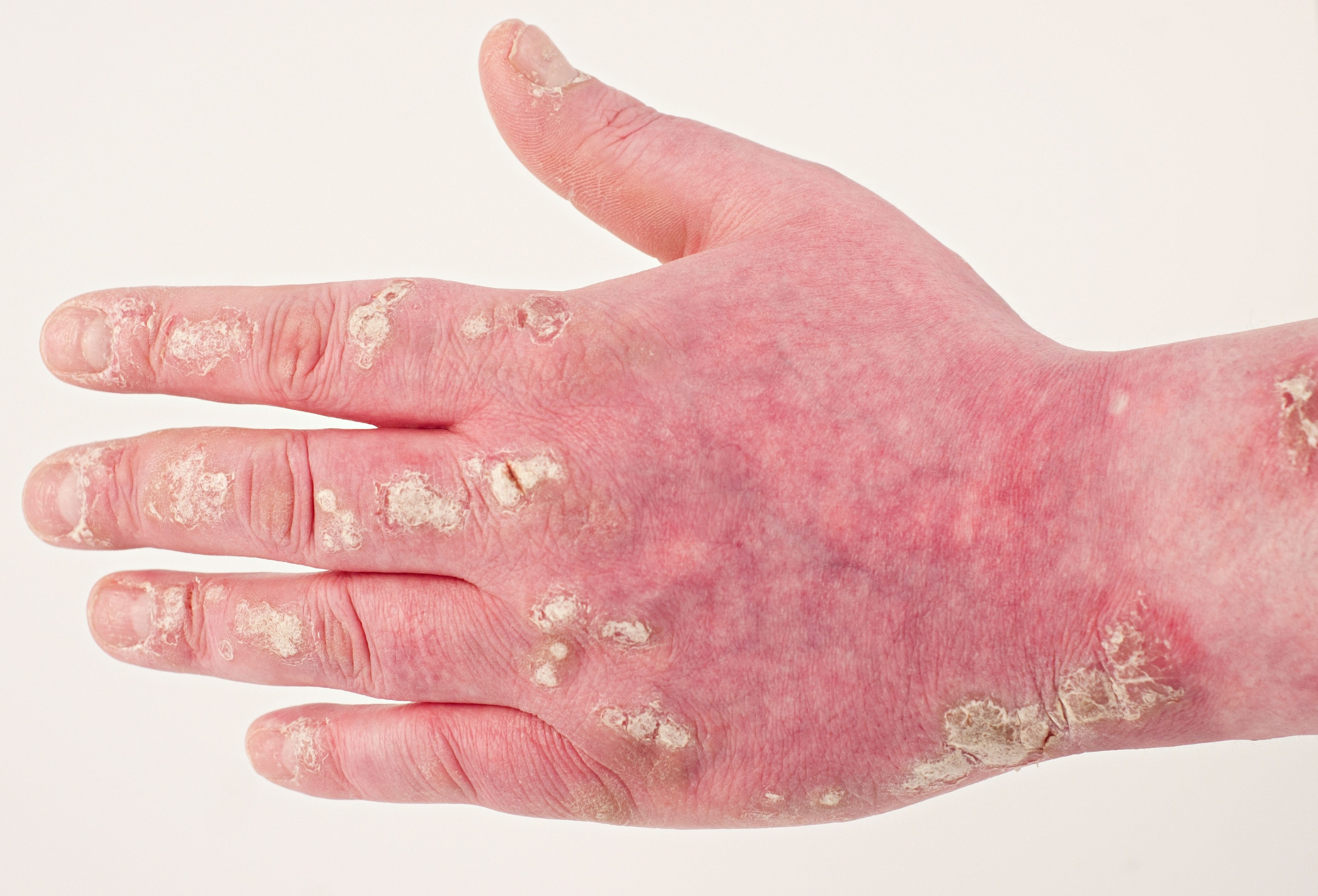 image of psoriasis