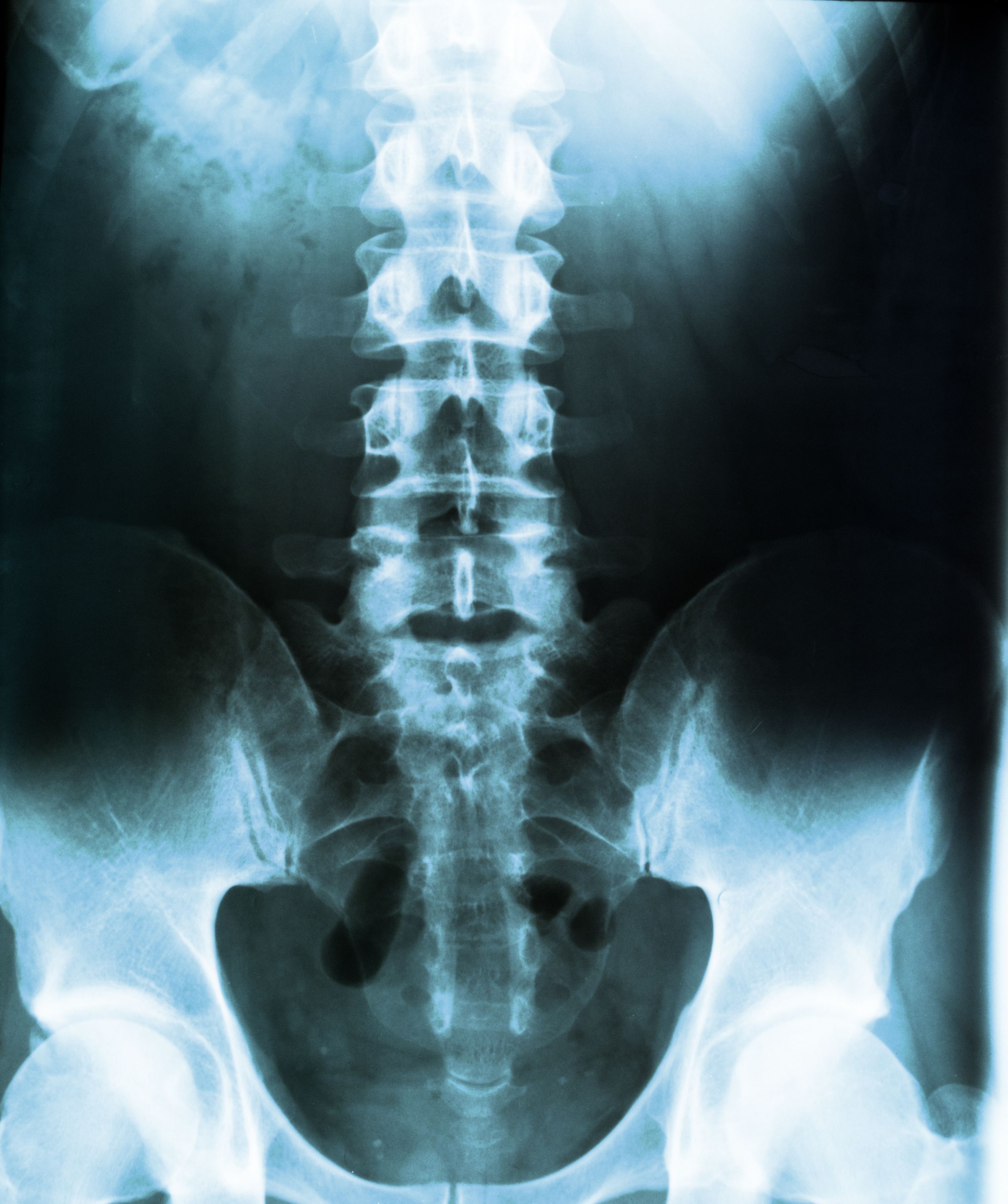 xray of spine