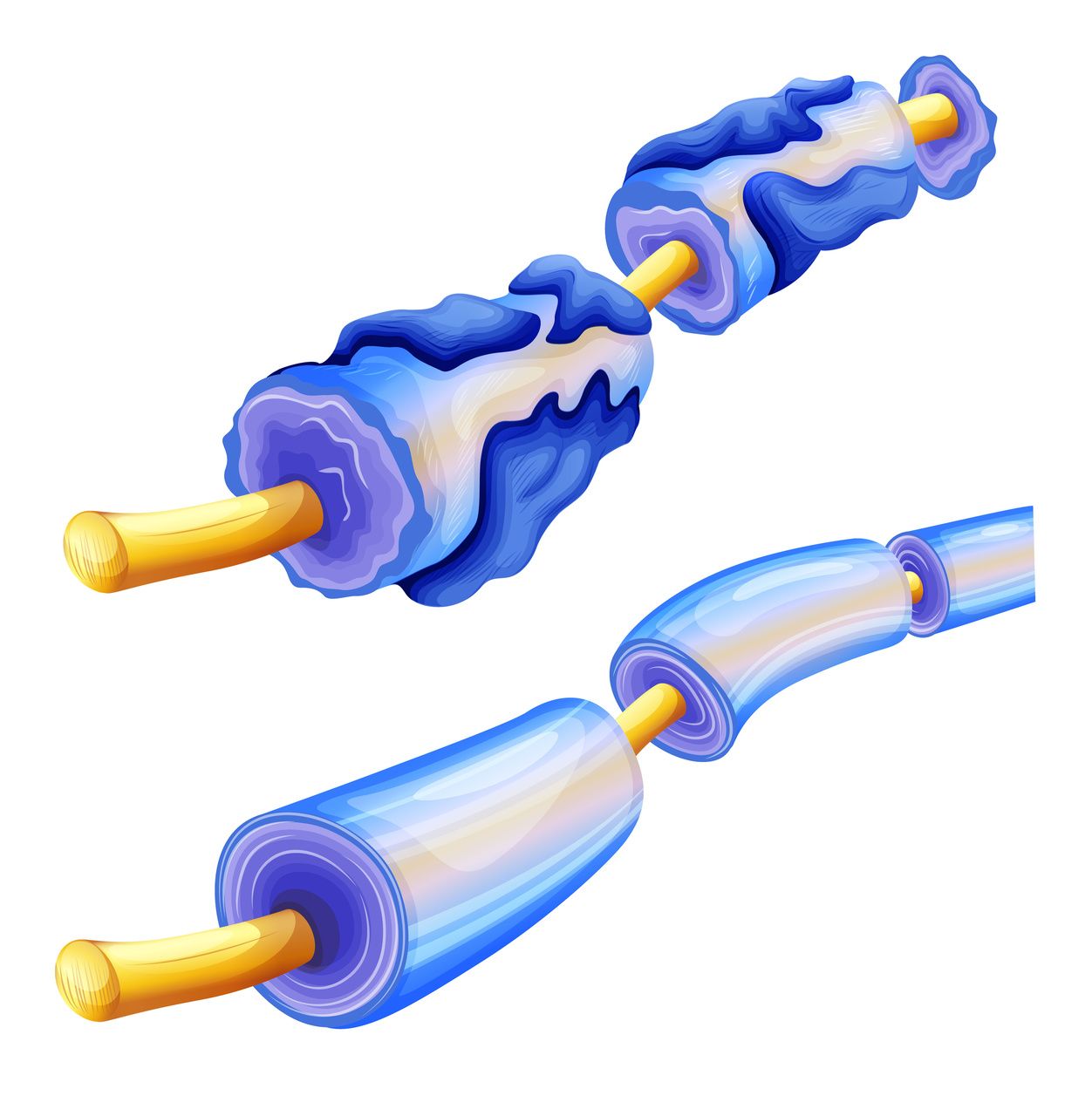 Degraded myelin sheath