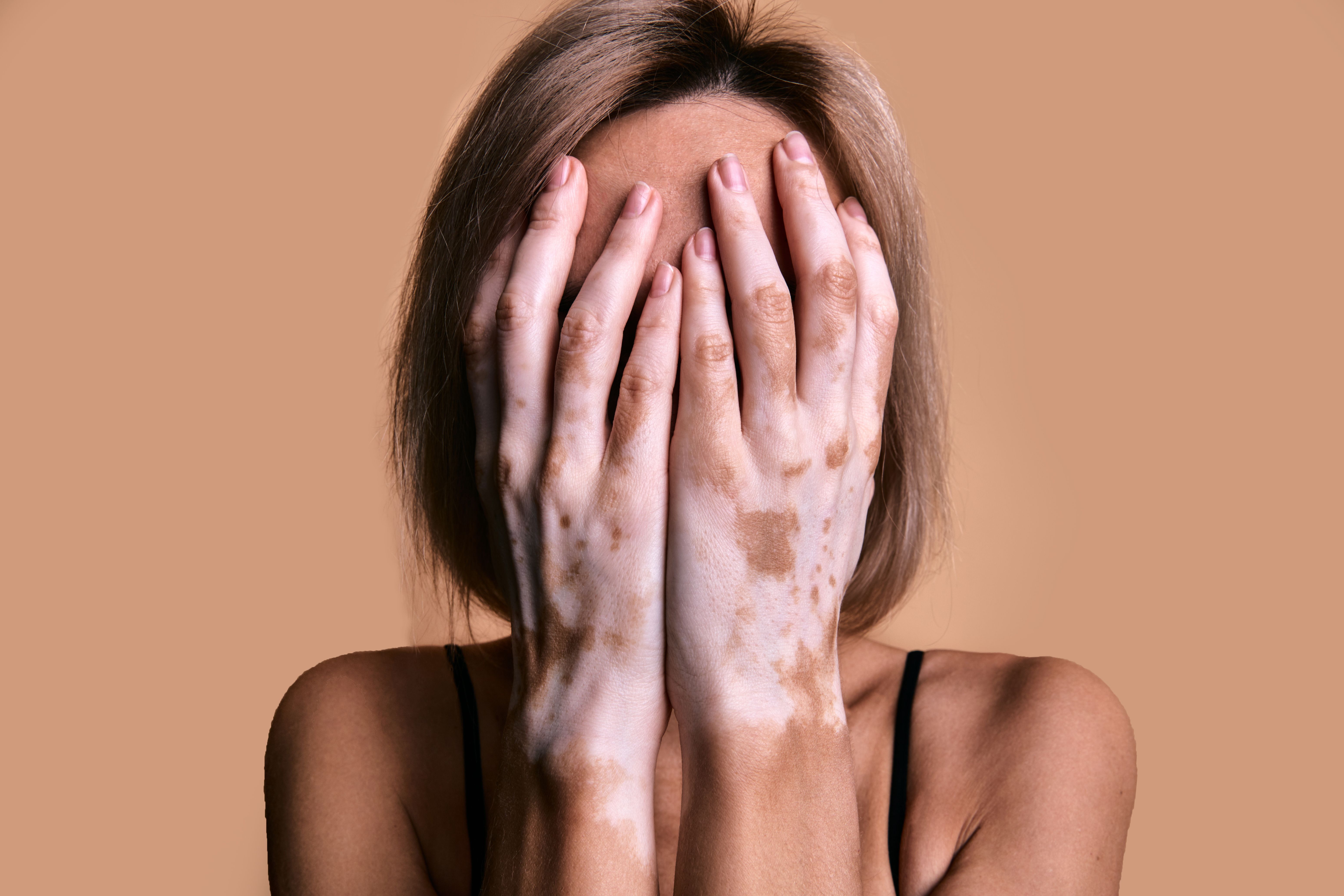 Woman with vitiligo covering face with her hands | Image Credit: Savory - stock.adobe.com