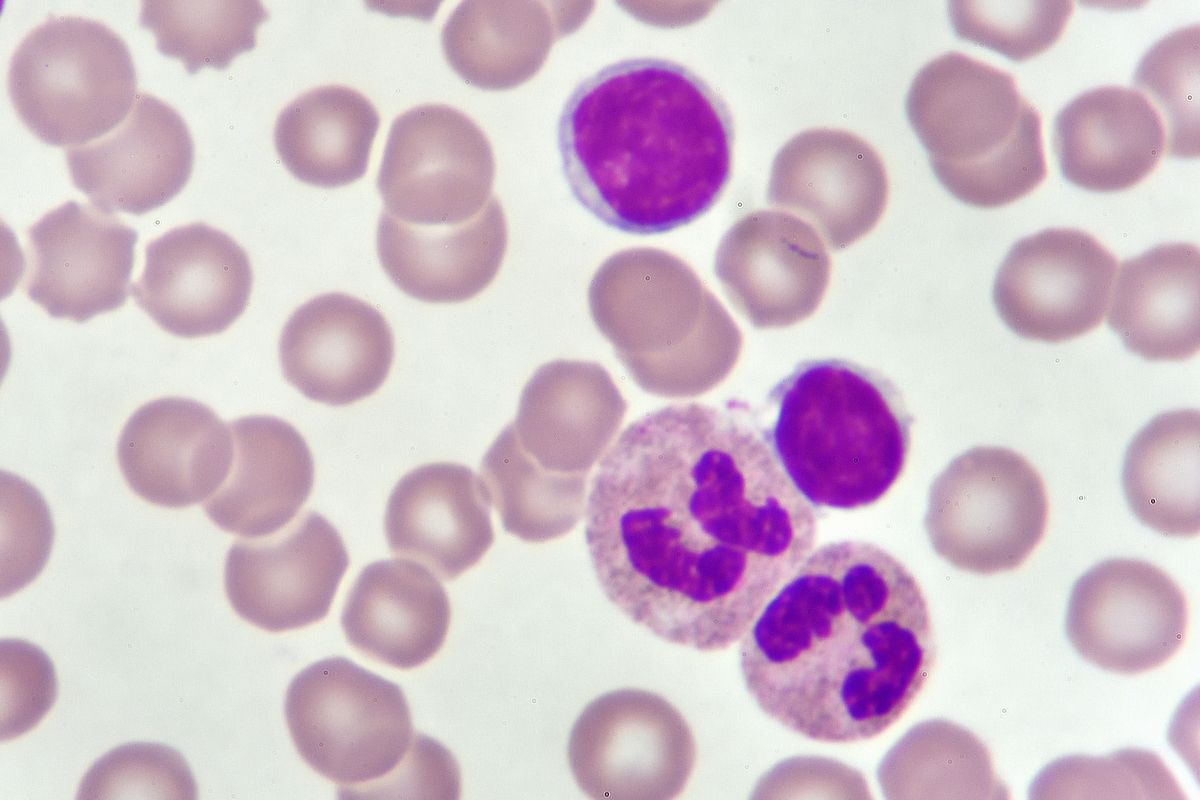 Chronic lymphocytic leukemia