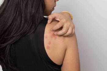 Urticaria symptoms | Image credit: suriya - stock.adobe.com