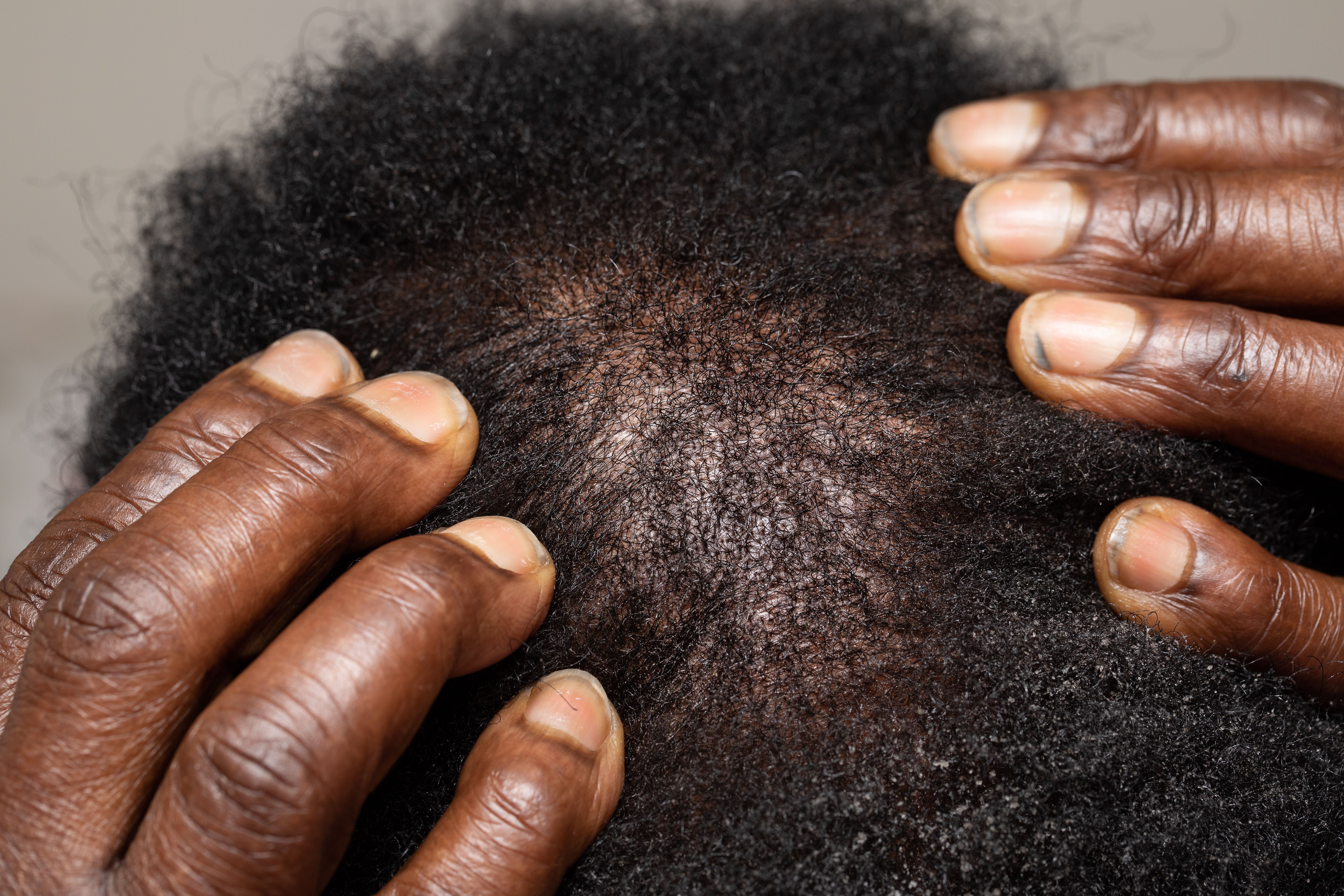 Thin hair loss on non-White man | Image Credit: Alessandro Grandini - stock.adobe.com