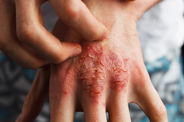 Hand with psoriasis | Image credit: Ольга Тернавская - stock.adobe.com
