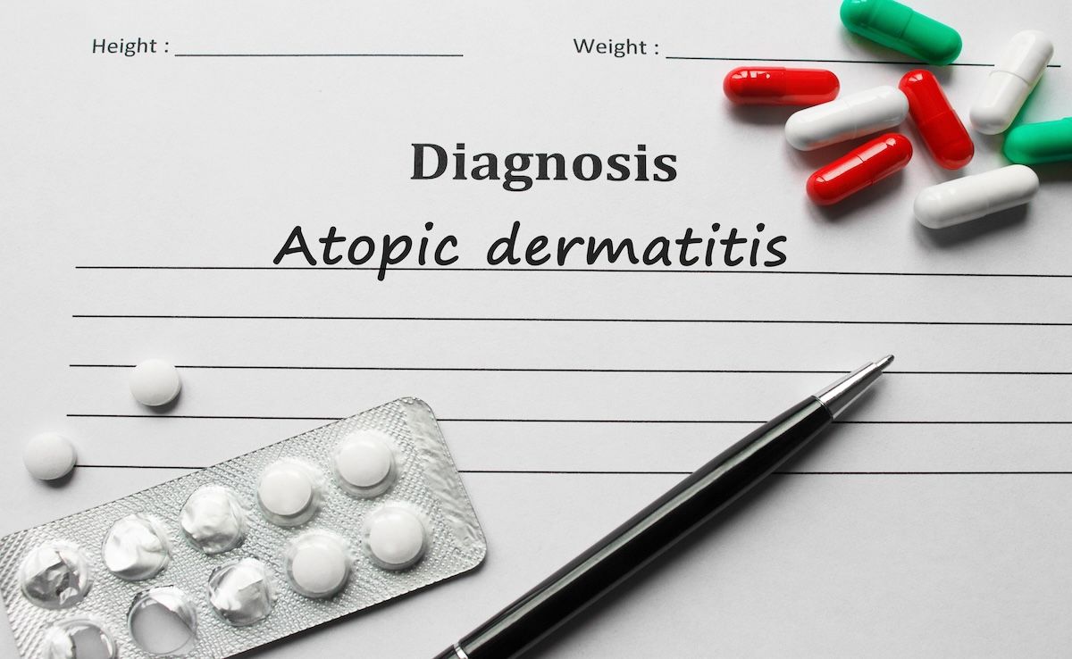 Atopic dermatitis diagnosis | Image Credit: MP Studio-stock.adobe.com