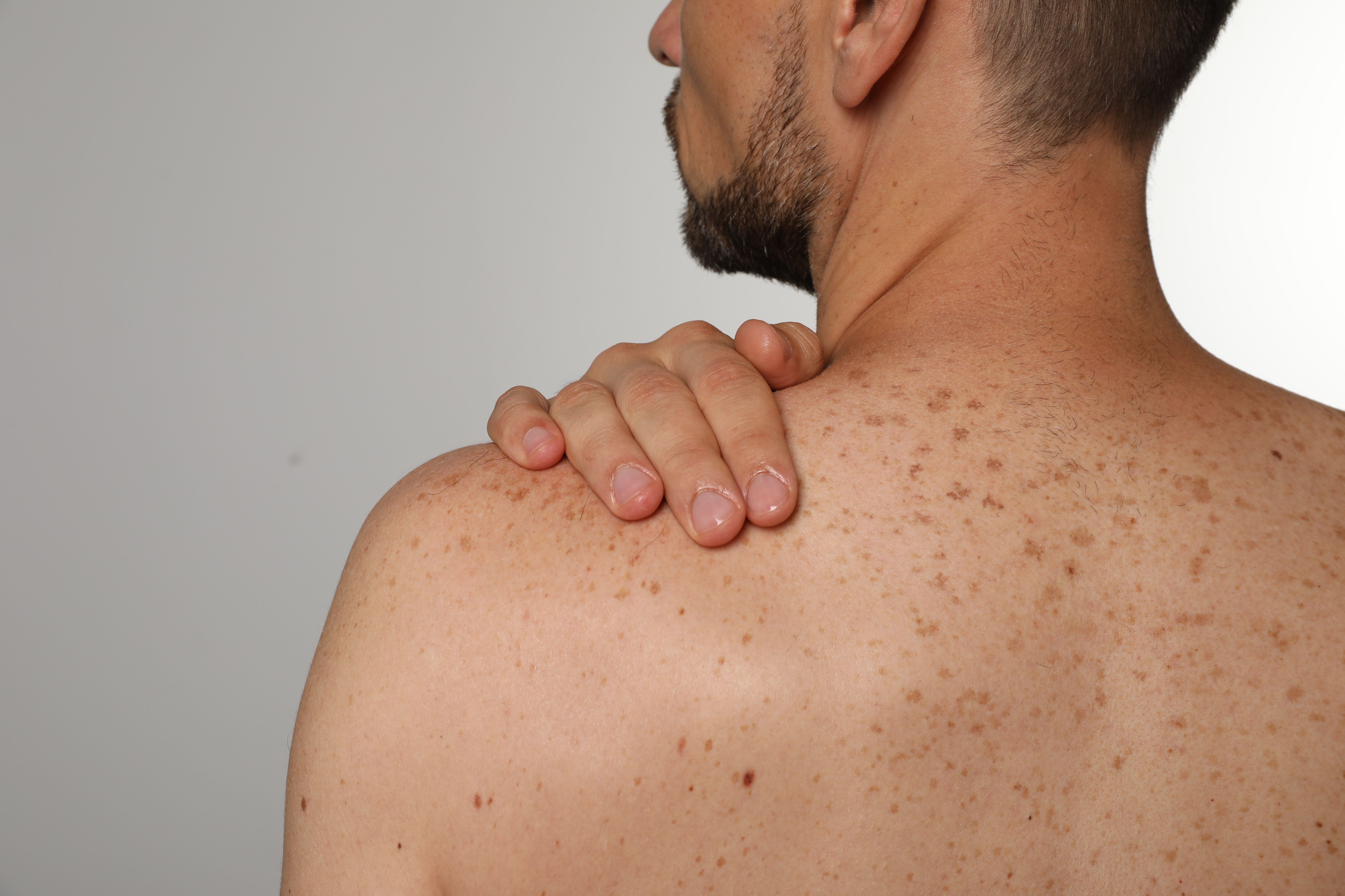 Man Prior to Skin Examination | image credit: New Africa - stock.adobe.com