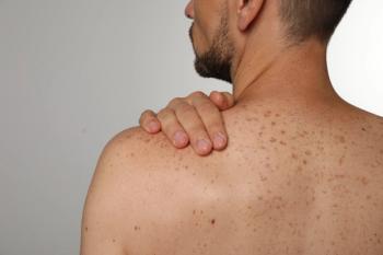 Man Prior to Skin Examination | image credit: New Africa - stock.adobe.com