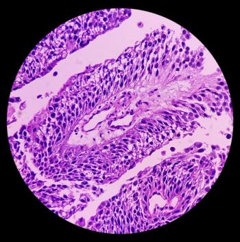 Metastatic urothelial carcinoma. | Image Credit: MdBabul  - stock.adobe.com 
