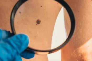 Patients who stopped adjuvant immunotherapy less than 12 months following metastatic melanoma resection did not experience inferior outcomes. | anna.stasiia - stock.adobe.com