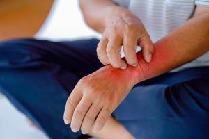 Man scratching bug bite itch psoriasis hand eczema | Image credit: Oporty786 - stock.adobe.com