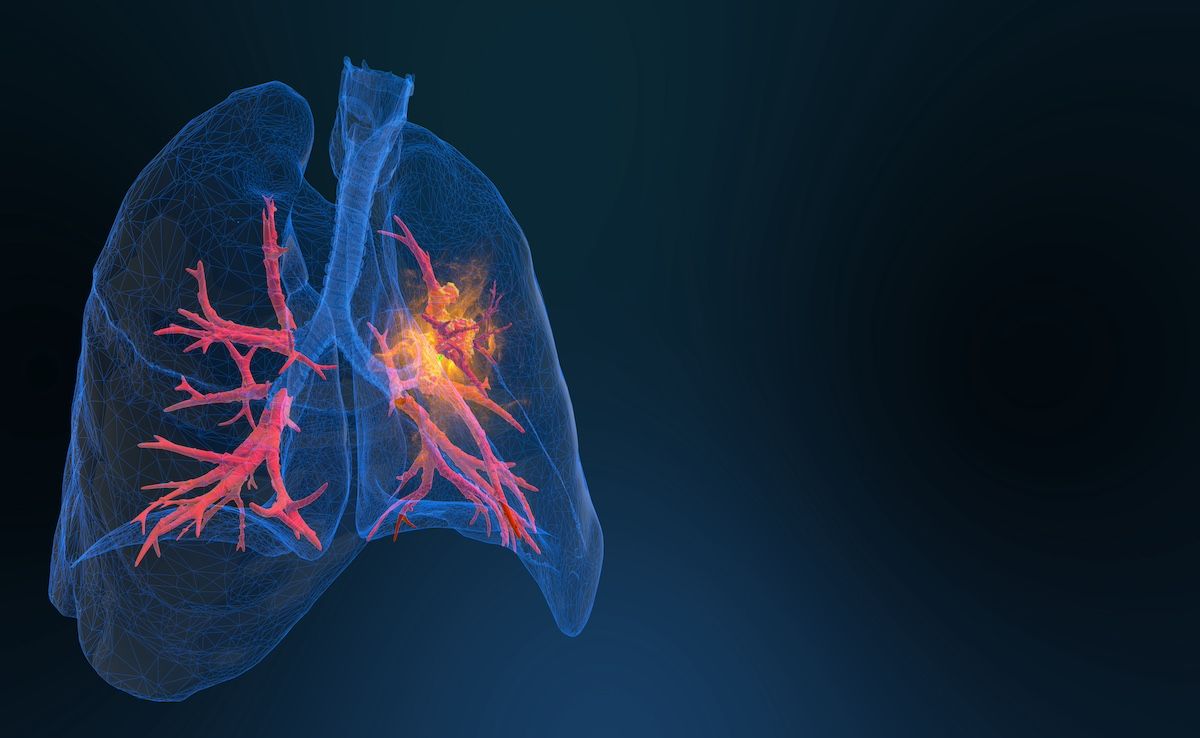 Lung cancer image | Image Credit: © appledesign-stock.adobe.com