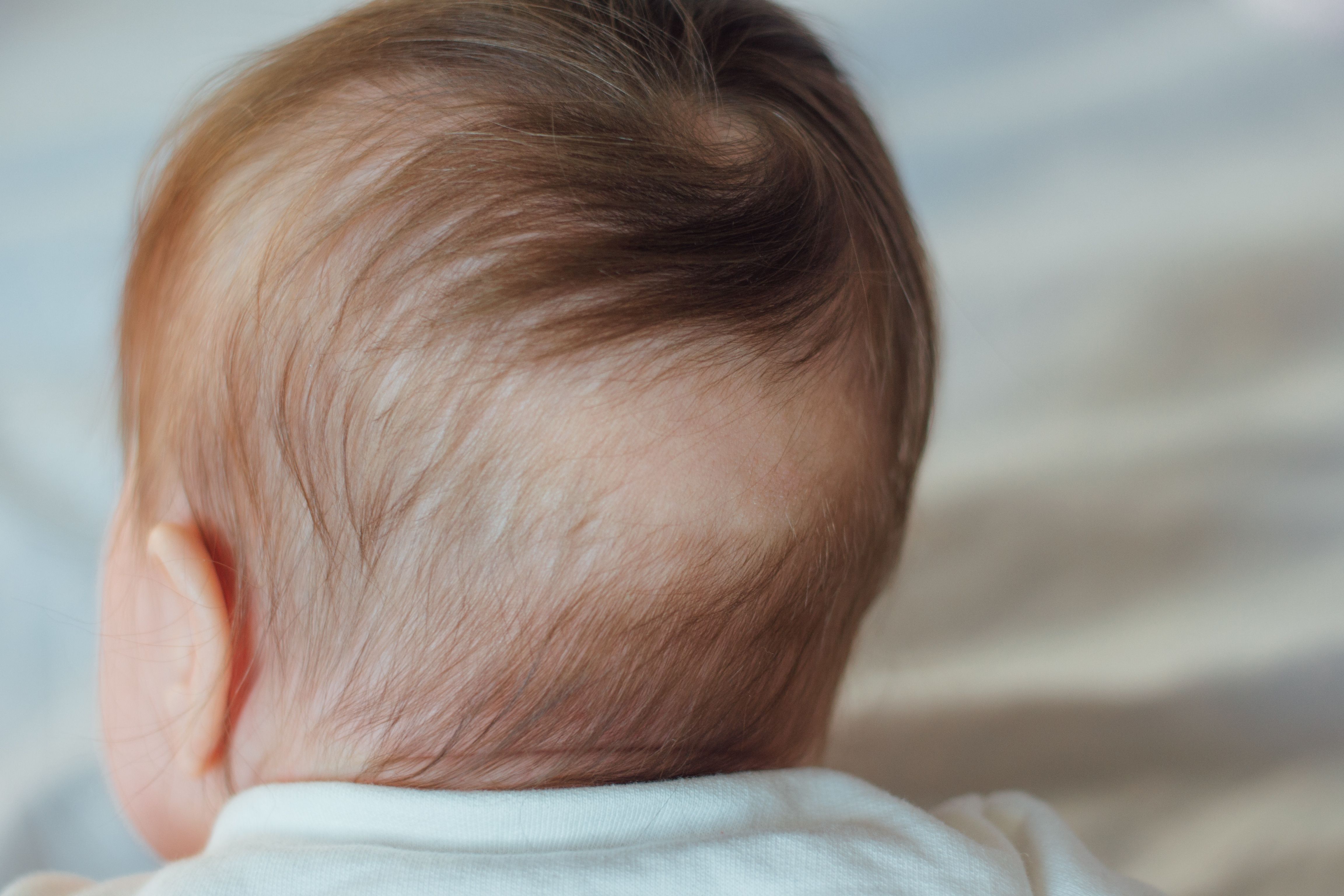 Pediatric hair loss | Image Credit: kaloriya - stock.adobe.com