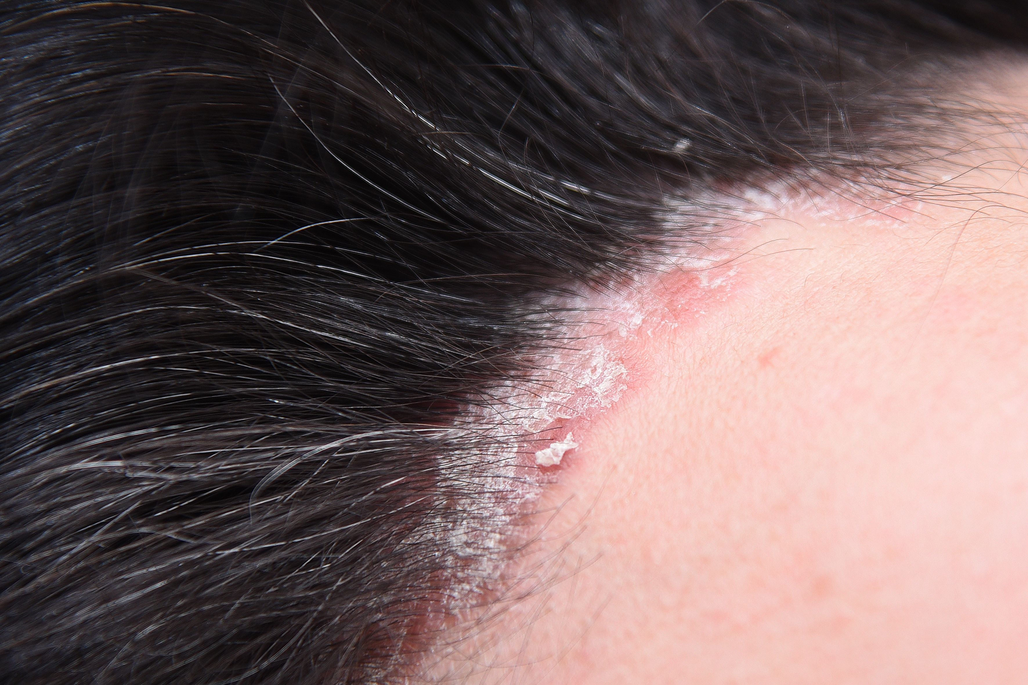 Plaque psoriasis | Image credit: ksu_ok - stock.adobe.com