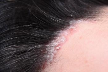 Plaque psoriasis | Image credit: ksu_ok - stock.adobe.com