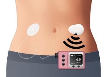 closed-loop insulin pump on body