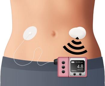 closed-loop insulin pump on body
