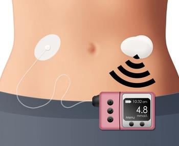 closed loop insulin delivery system