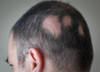Man with bald patches - alex papp - adobe.stock.com